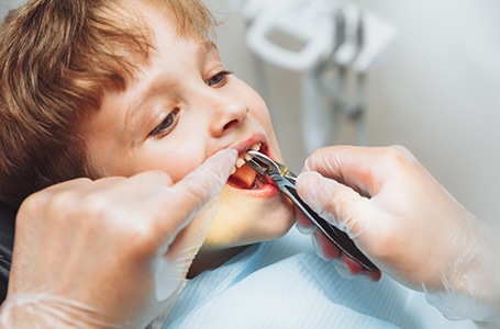 There are a variety of factors that could affect the cost of your child’s tooth extraction
