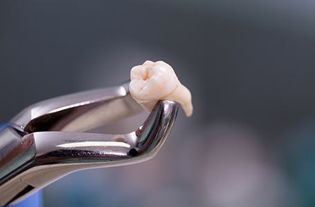 Factors that can affect the cost of tooth extraction include the location of the tooth needing extraction